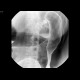 Crohn's disease, colitis: RF - Fluoroscopy